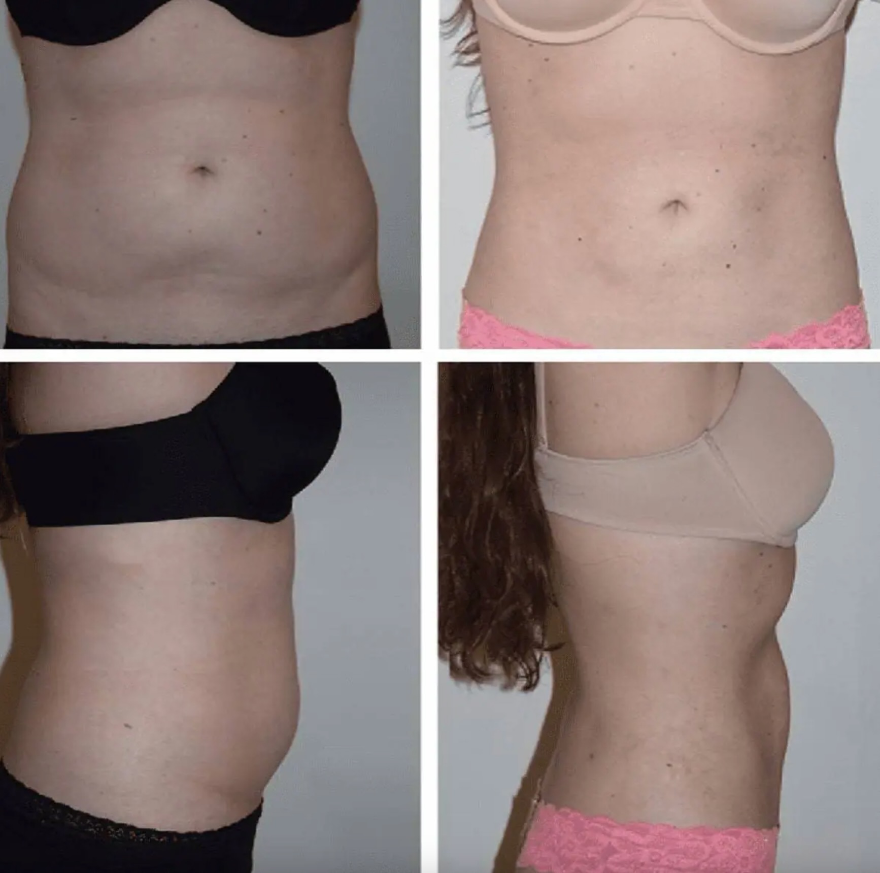 Abdomen, Waist, and Lipo 360 photographs, Photo 65.
