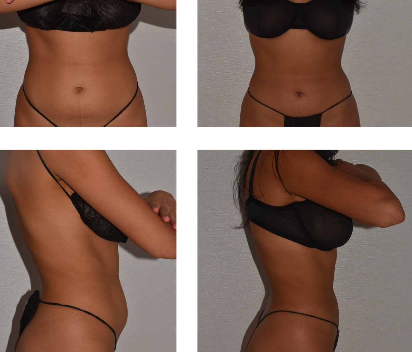 Abdomen, Waist, and Lipo 360 photographs, Photo 195.
