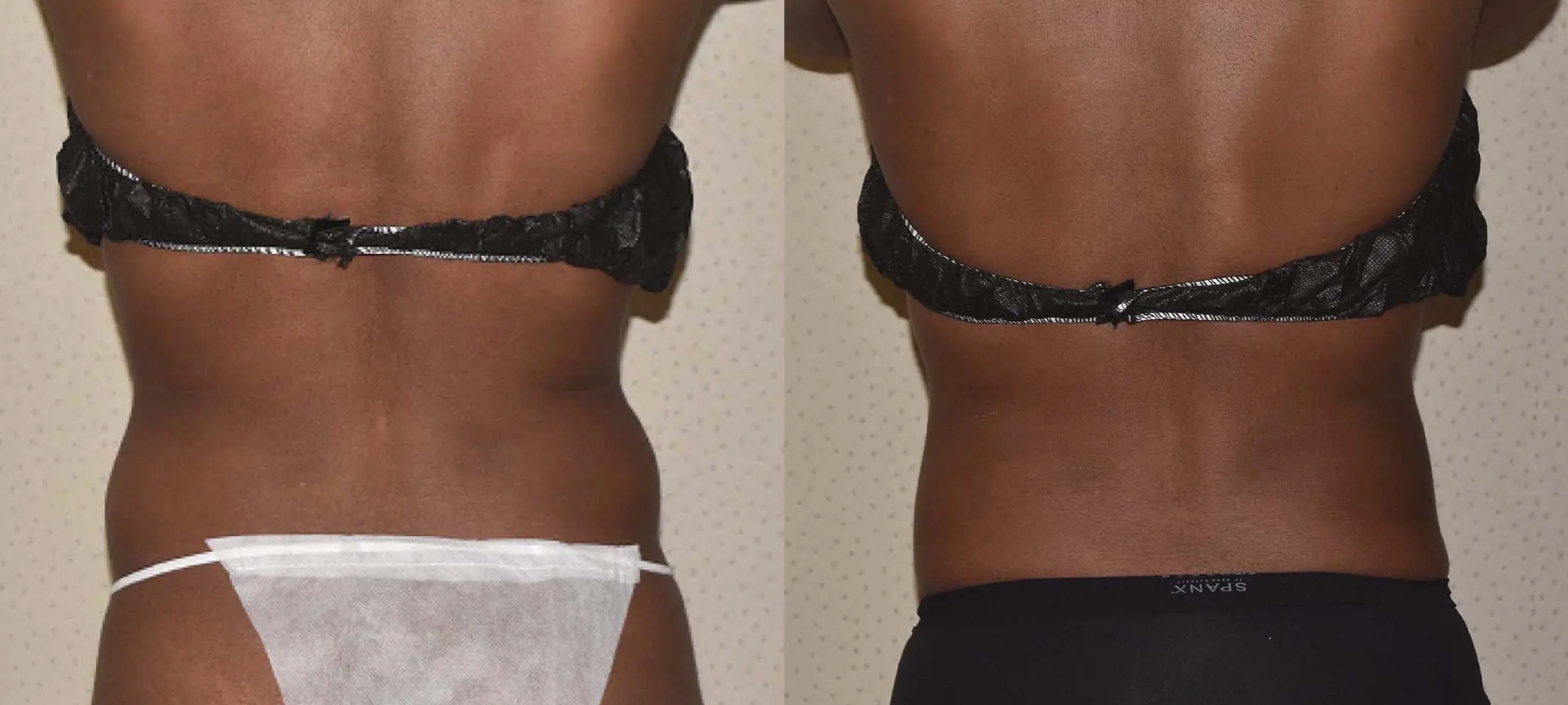 Abdomen, Waist, and Lipo 360 photographs, Photo 30.