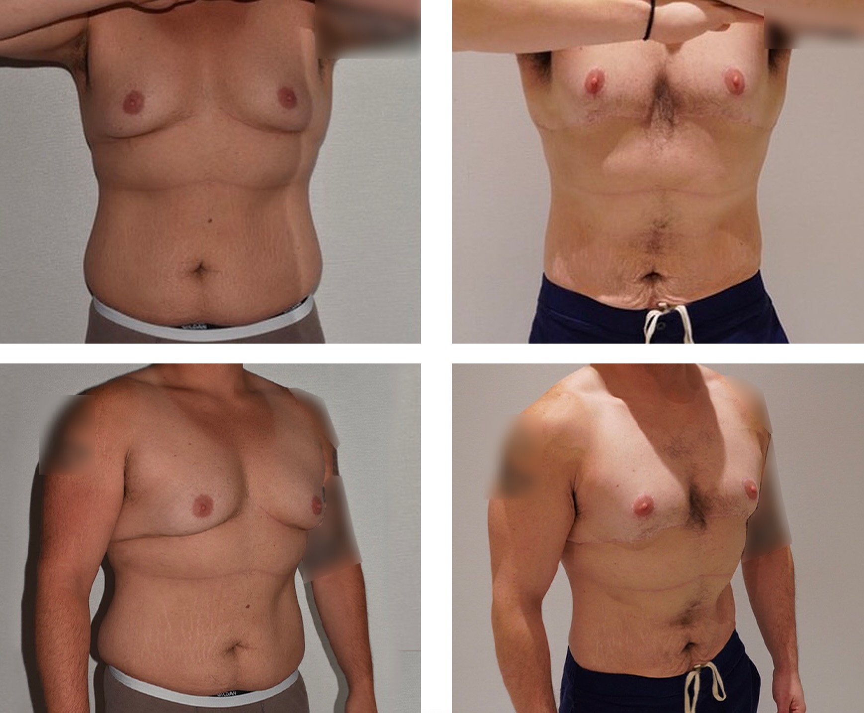Abdomen, Waist, and Lipo 360 photographs, Photo 55.