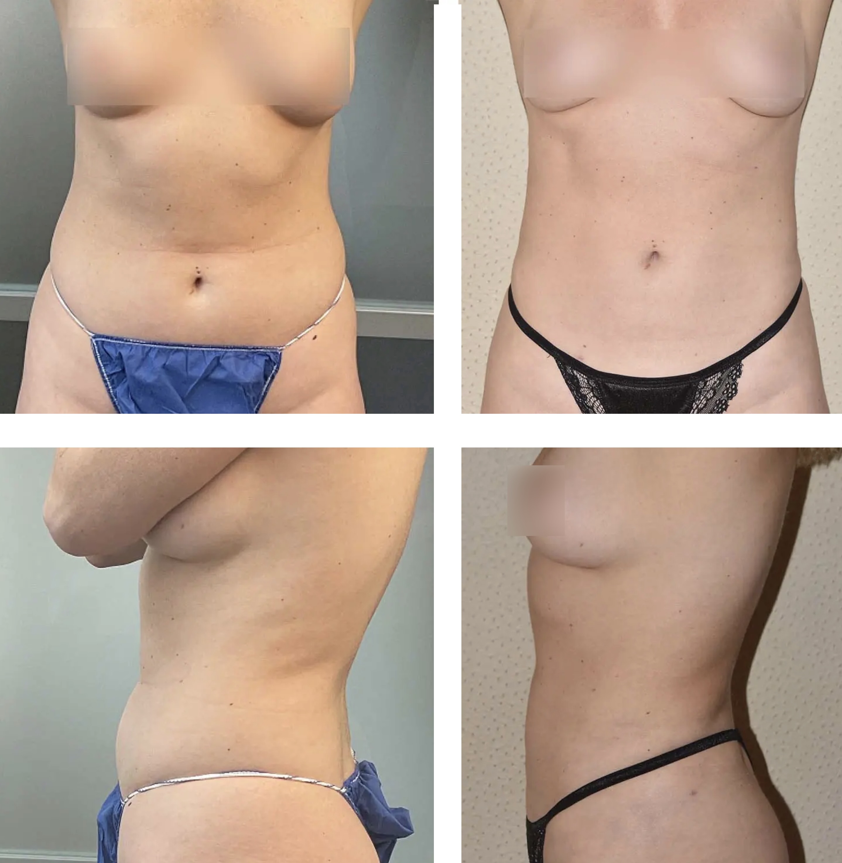 Abdomen, Waist, and Lipo 360 photographs, Photo 66.