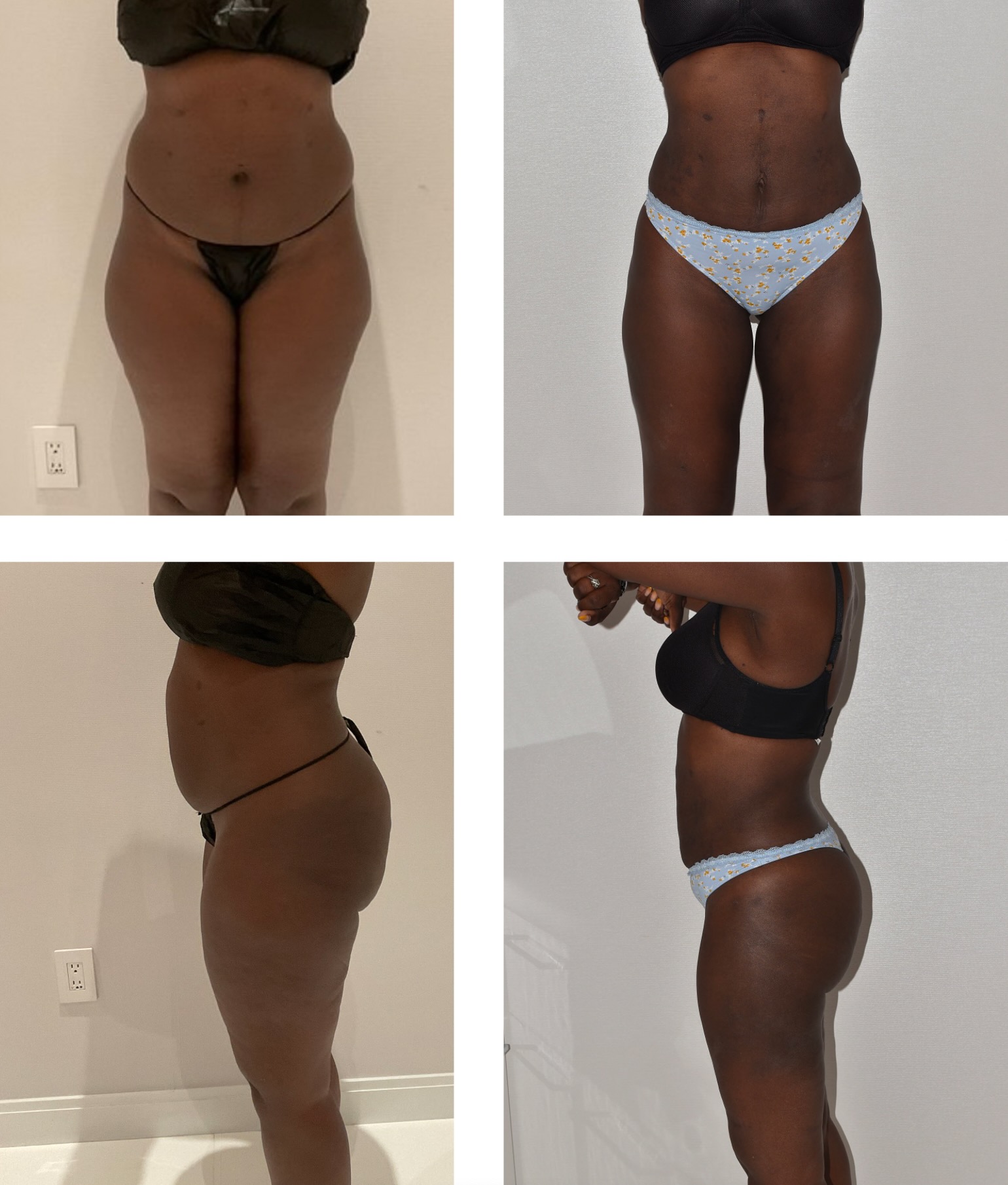 Abdomen, Waist, and Lipo 360 photographs, Photo 86.