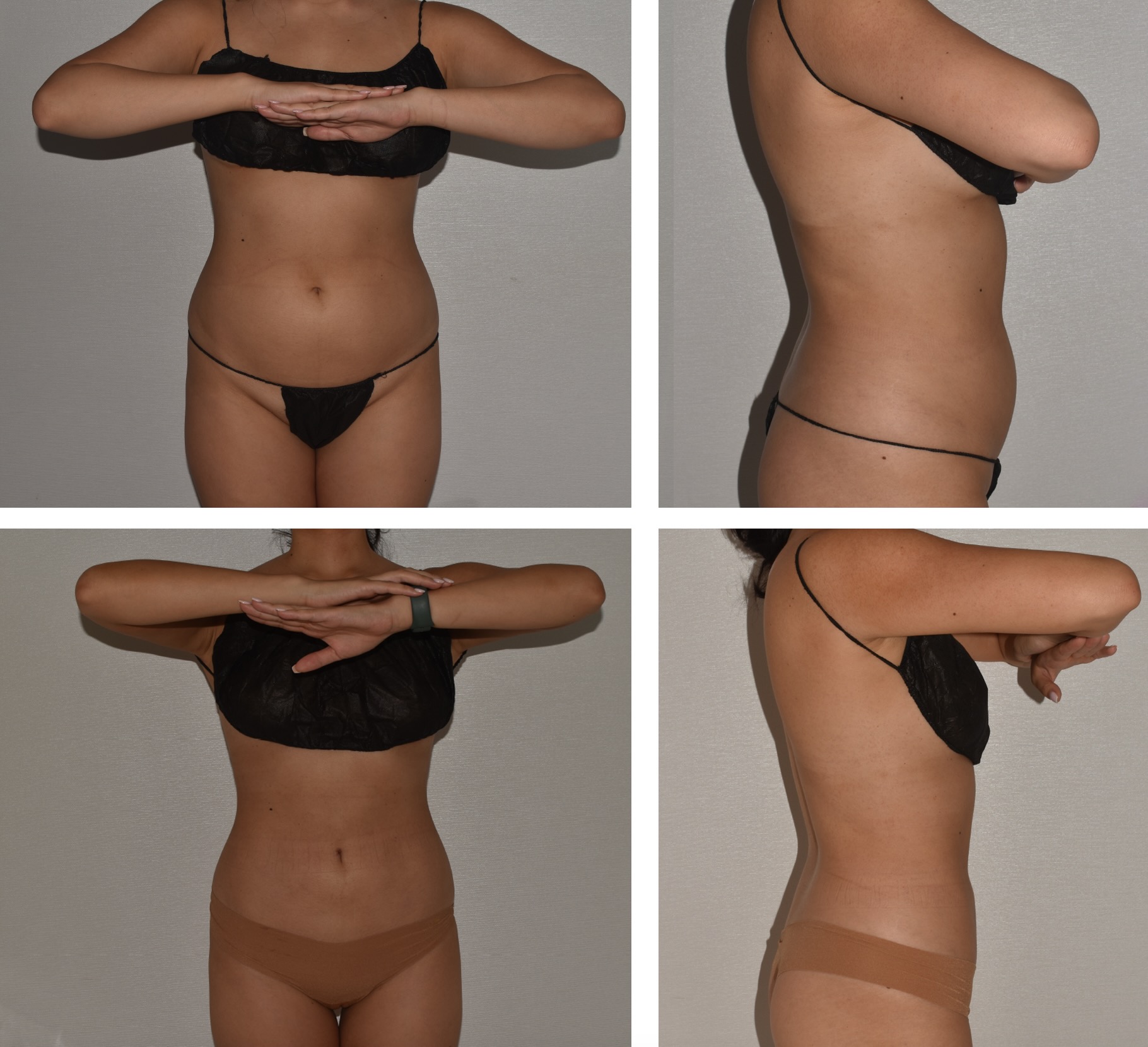 Abdomen, Waist, and Lipo 360 photographs, Photo a9.
