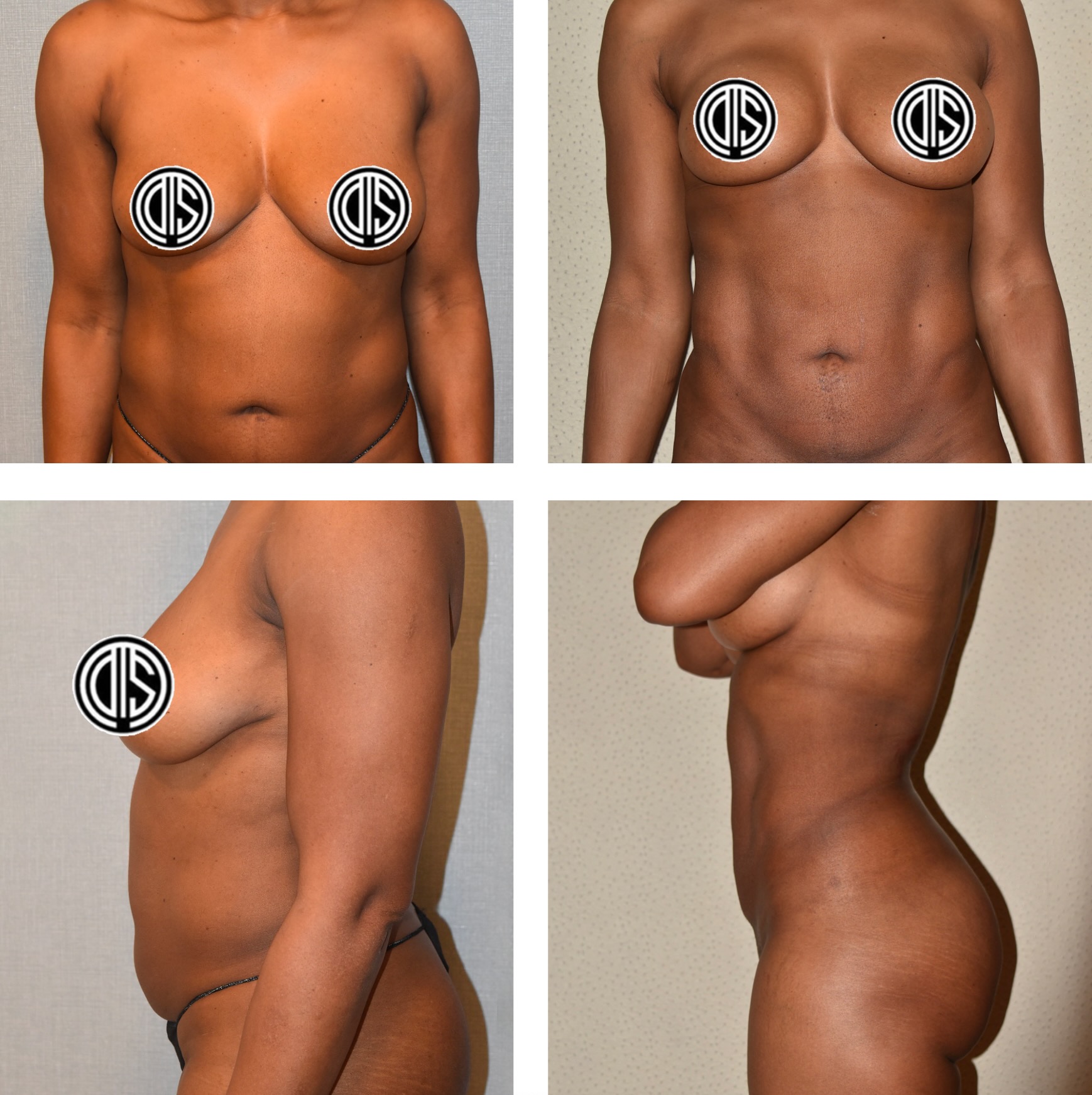 Abdomen, Waist, and Lipo 360 photographs, Photo 87.