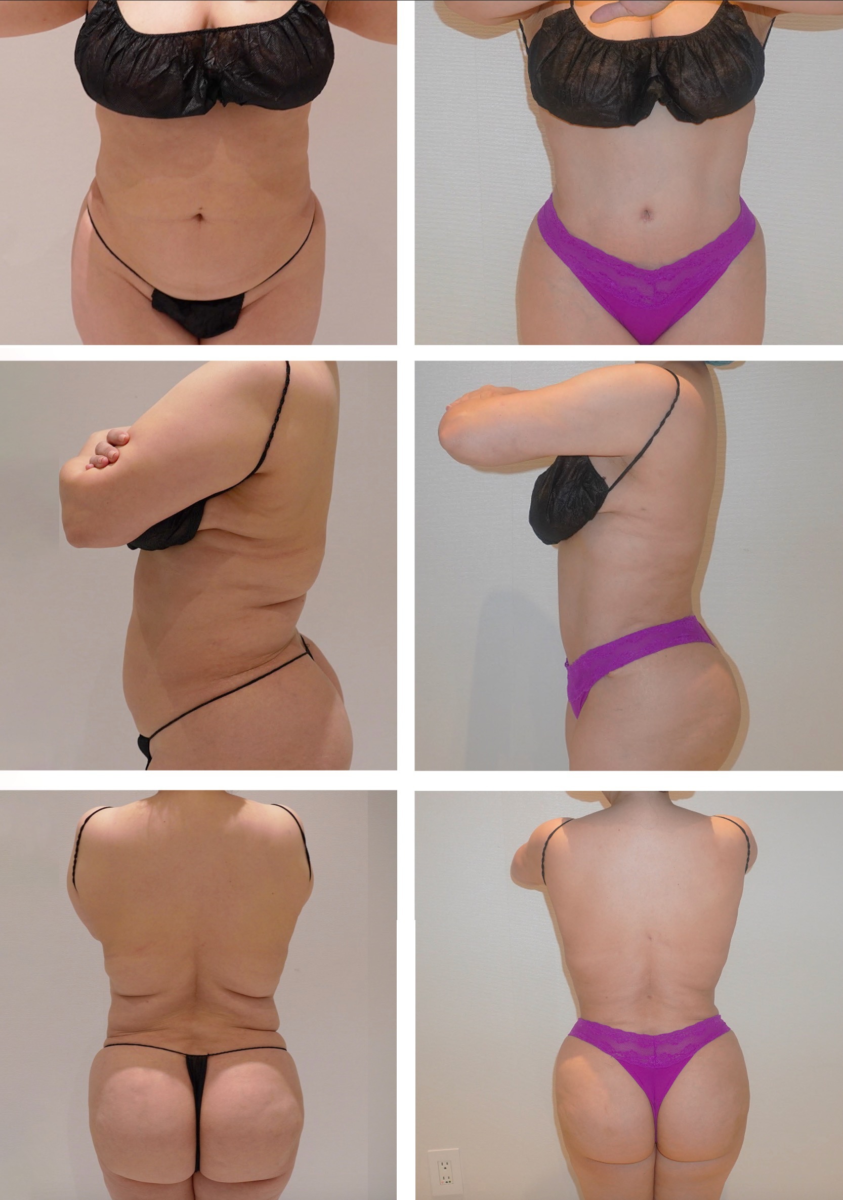 Abdomen, Waist, and Lipo 360 photographs, Photo 71.