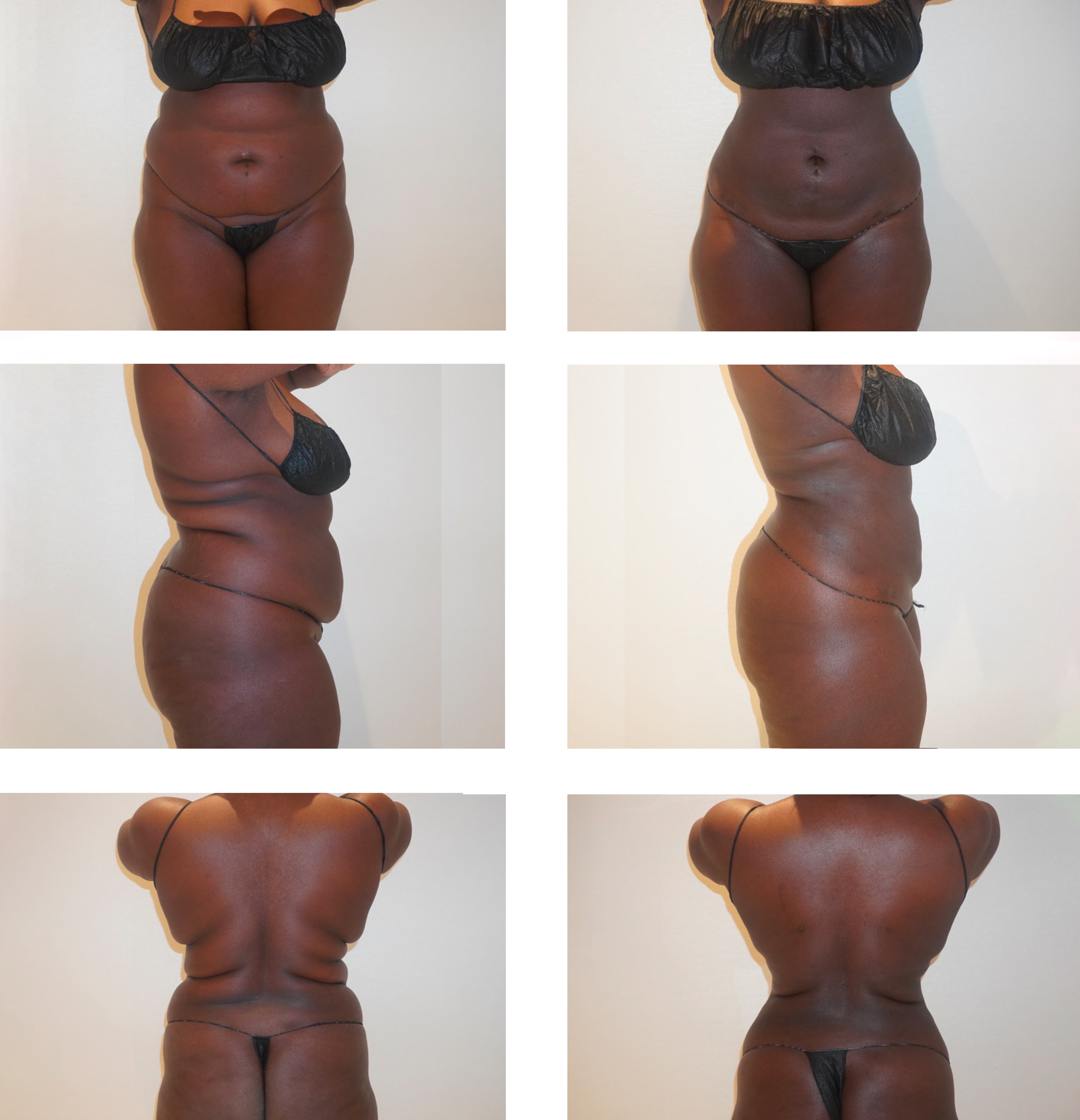 Abdomen, Waist, and Lipo 360 photographs, Photo 70.