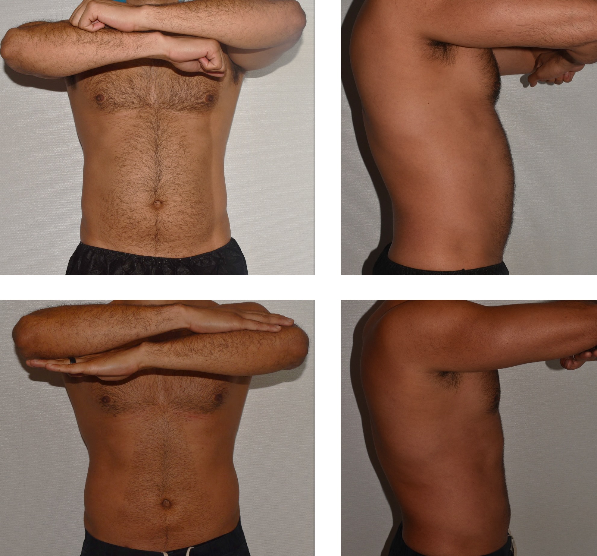 Abdomen, Waist, and Lipo 360 photographs, Photo 32.