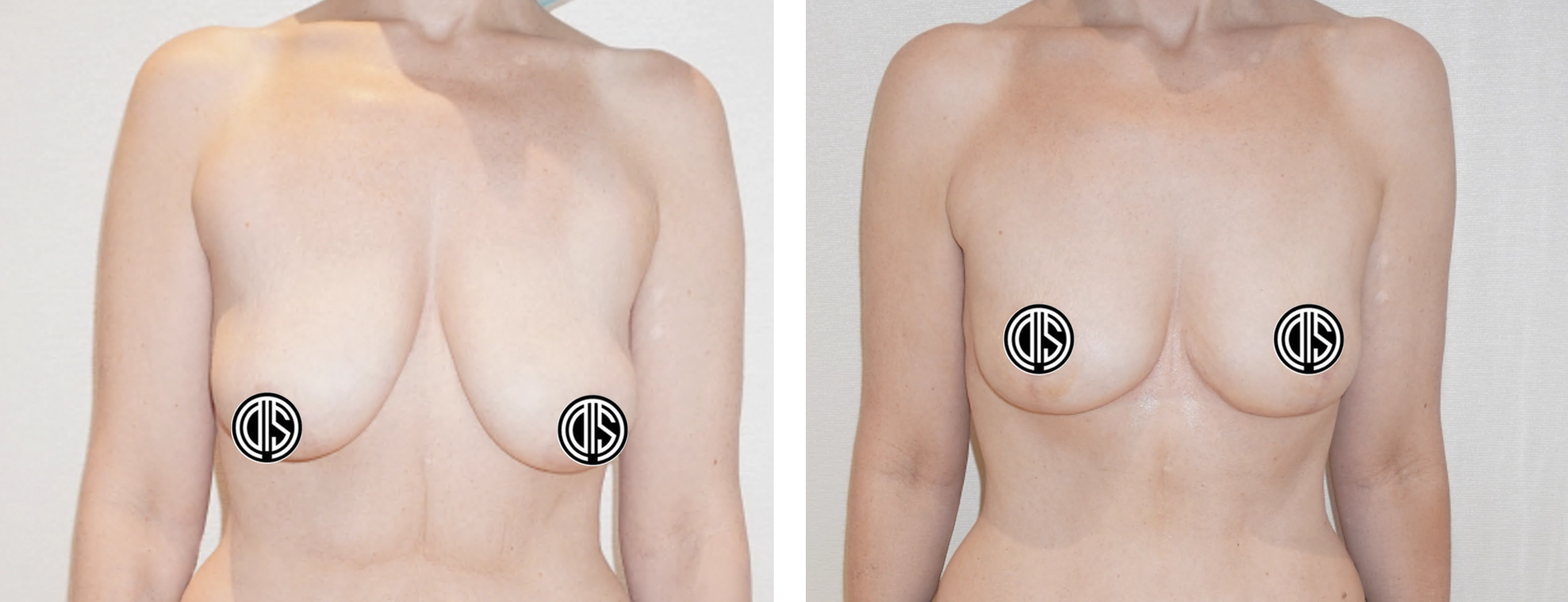Front view before and after inverted-T breast reduction and lift in a 40-year-old woman after significant weight loss.