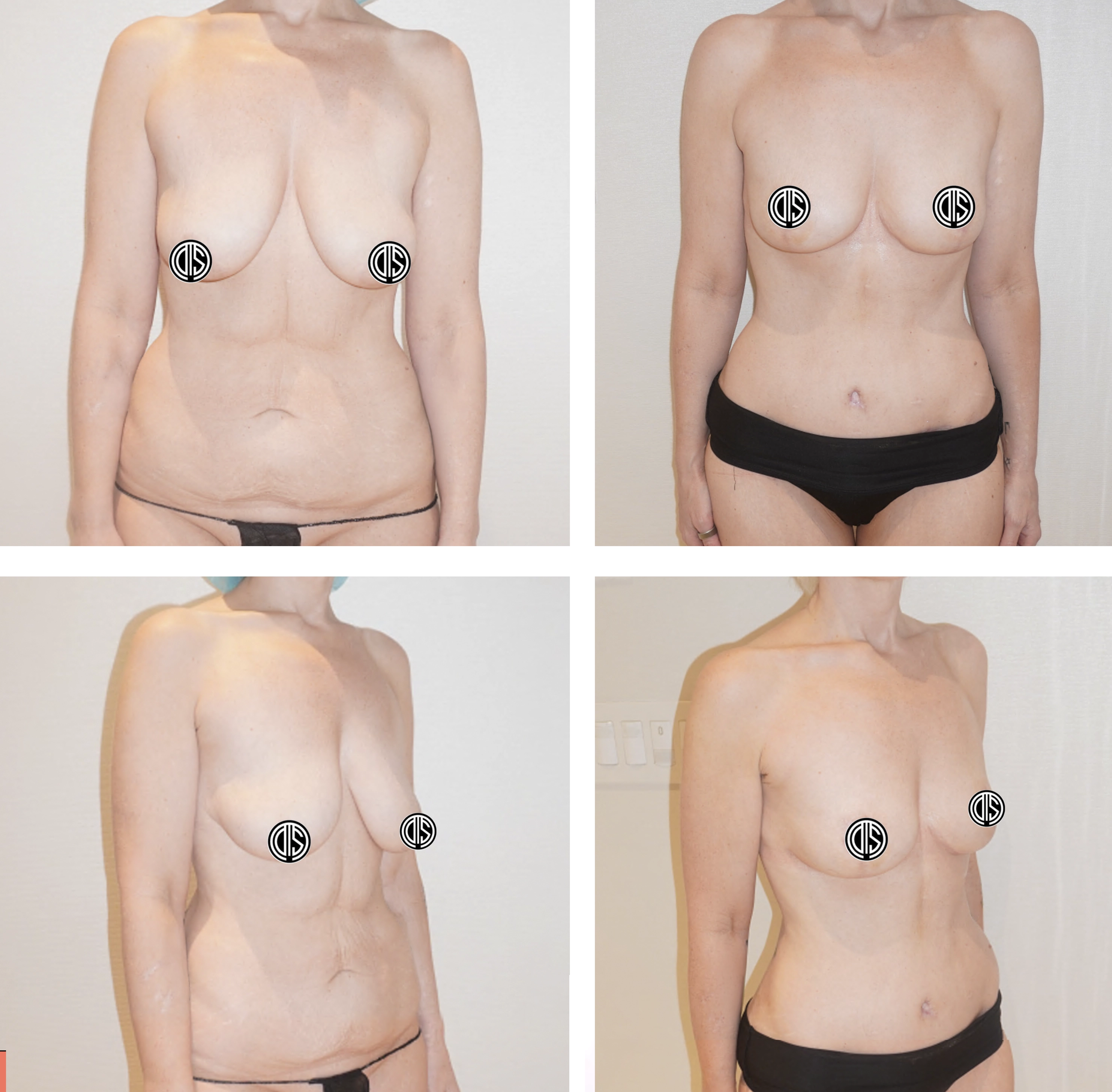 Before and after inverted-T breast reduction and lift with abdominoplasty following significant weight loss. Individual results vary.