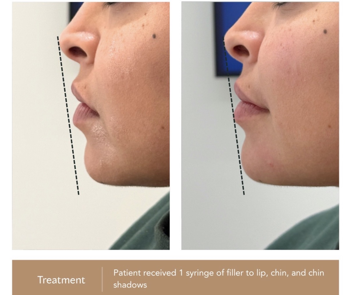 Chin and lip filler before and after photographs — Medical Aesthetics Case 9.