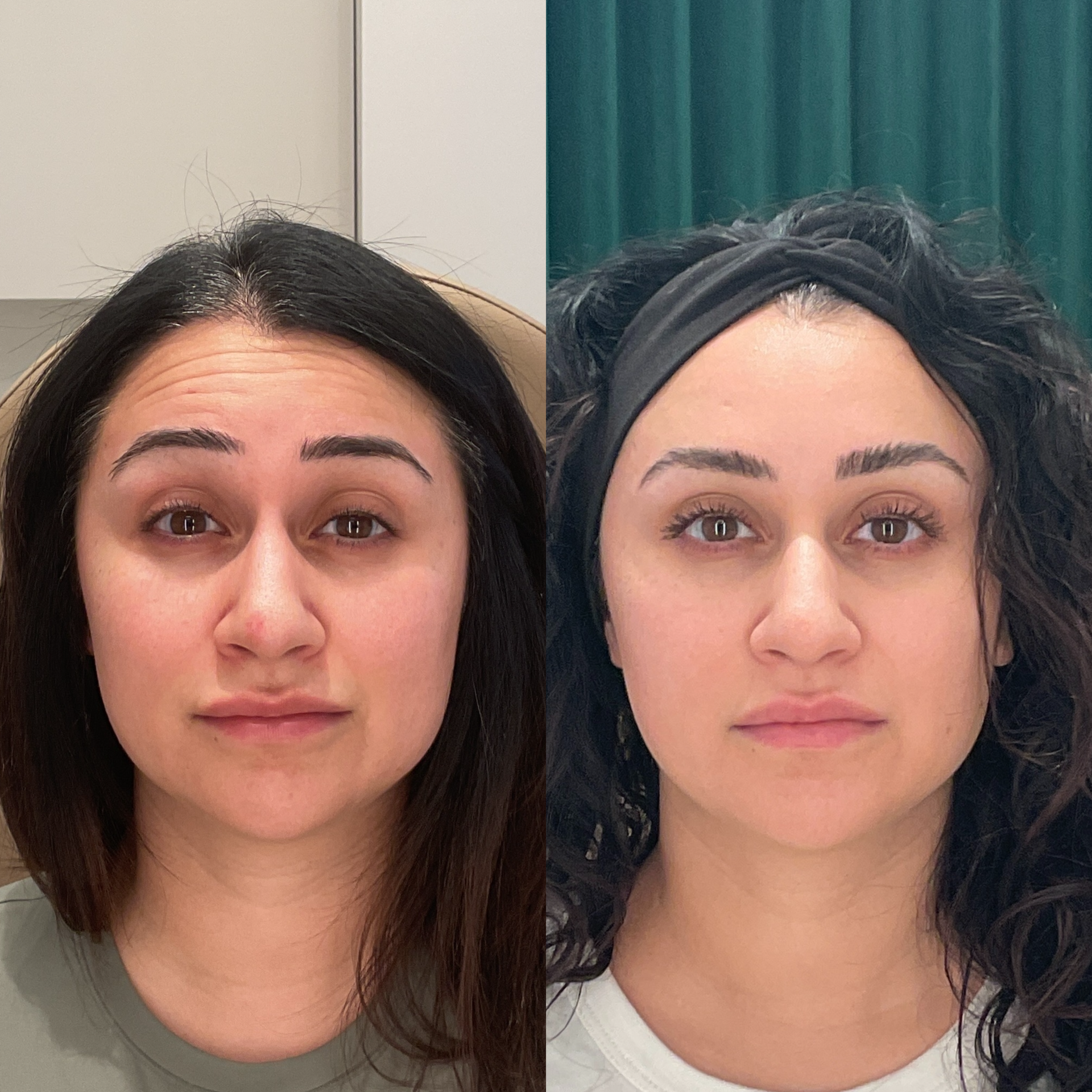 Botox before and after photographs — Medical Aesthetics Case 1.