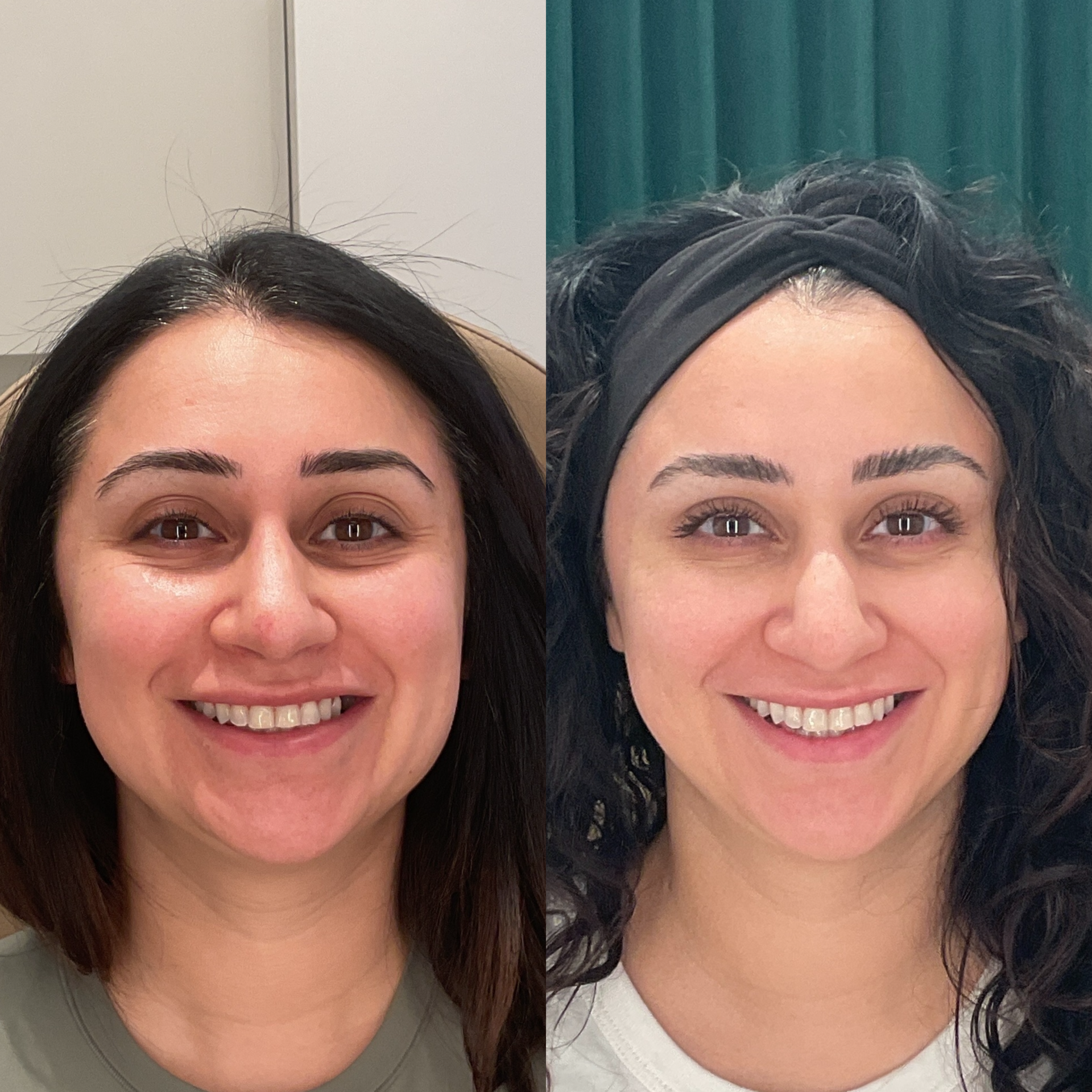 Botox before and after photographs — Medical Aesthetics Case 6.