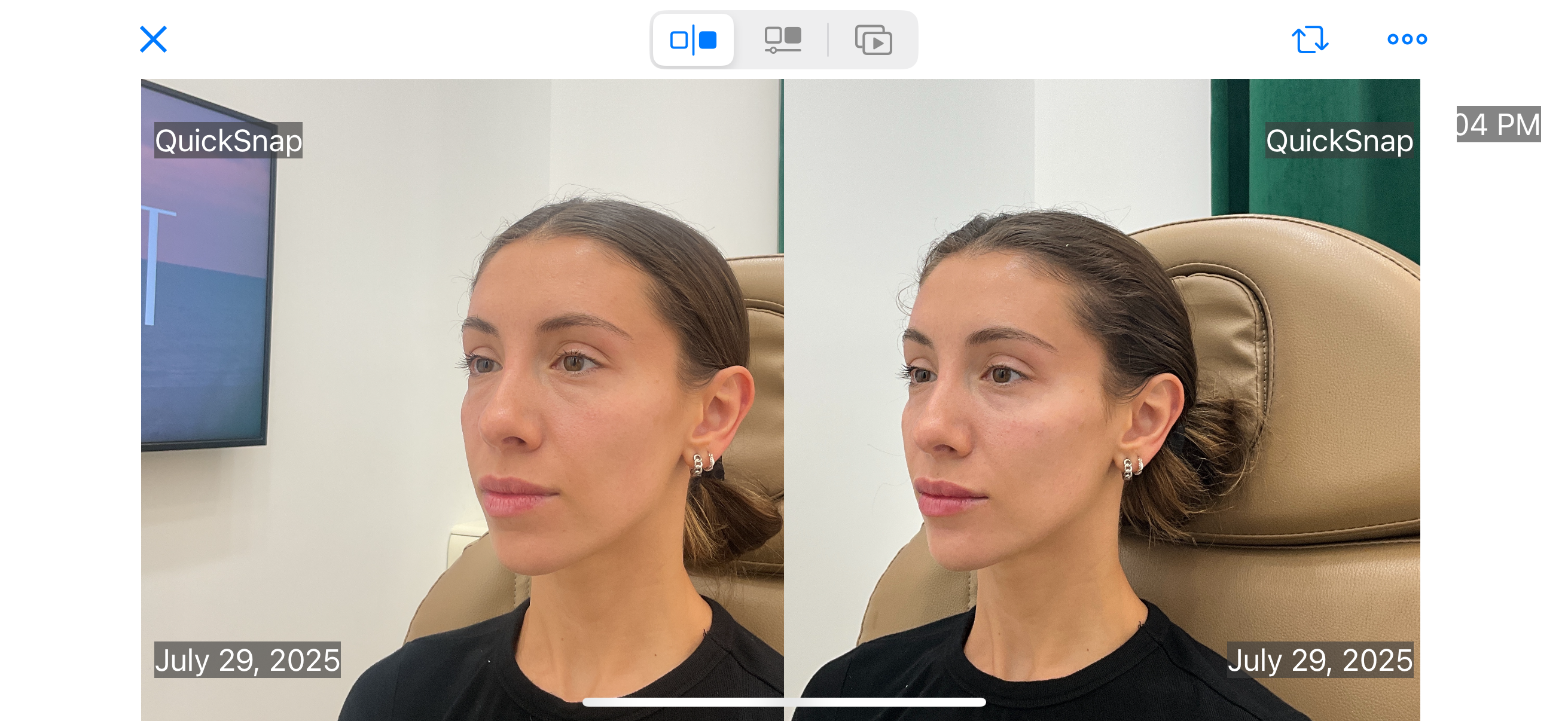 Facial balancing with filler before and after photographs — Medical Aesthetics Case 10.