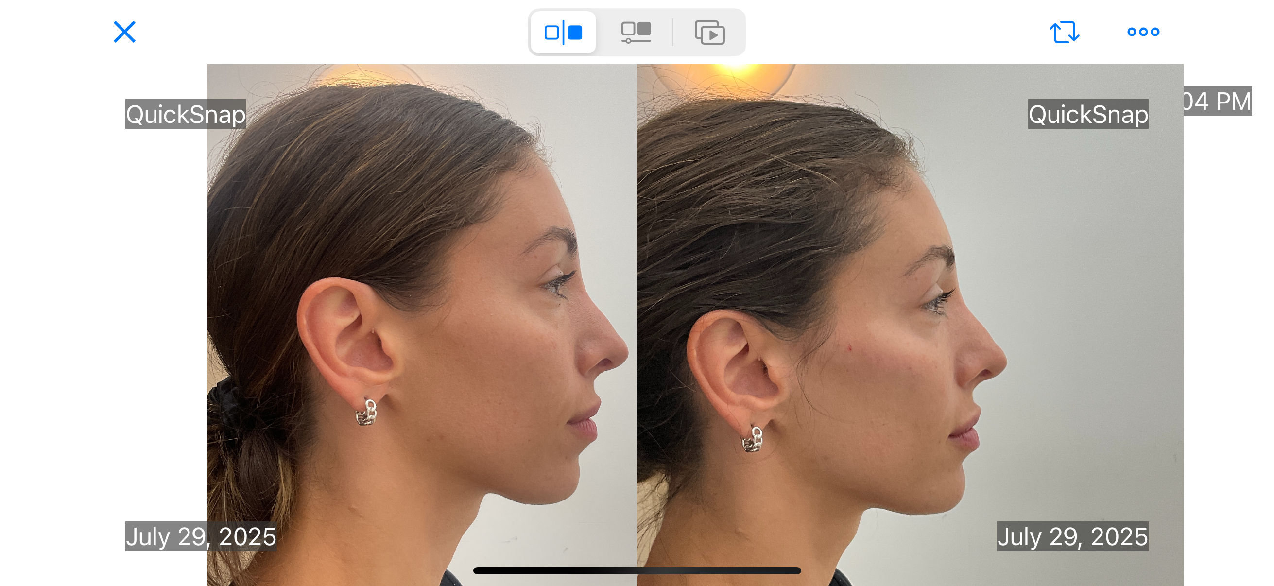 Facial balancing with filler before and after photographs — Medical Aesthetics Case 12.
