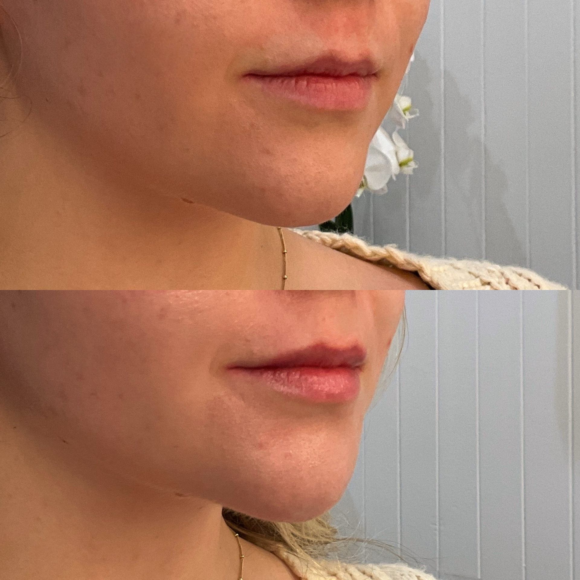 Lip filler before and after photographs — Medical Aesthetics Case 18.