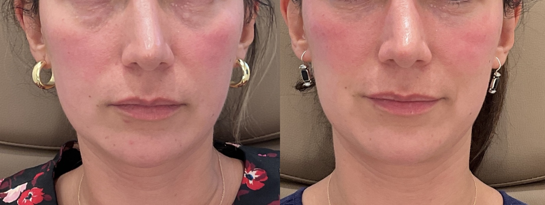 Lip filler before and after photographs — Medical Aesthetics Case 22.