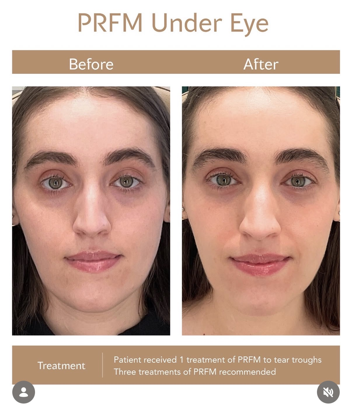 Under-eye PRFM before and after photographs — Medical Aesthetics Case 32.