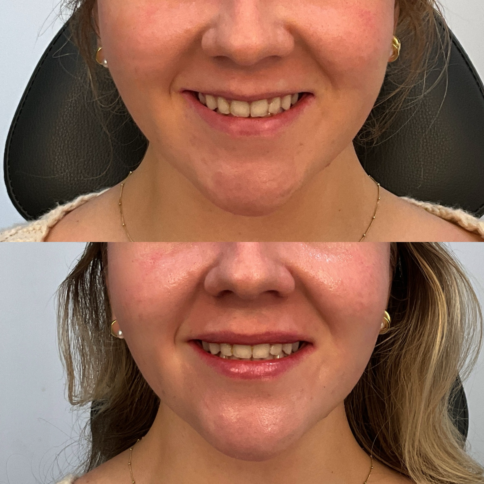 Lip filler before and after photographs — Medical Aesthetics Case 24.