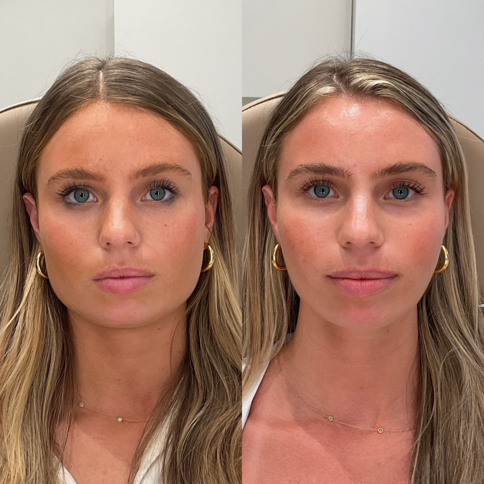 Masseter Botox before and after photographs — Medical Aesthetics Case 27.