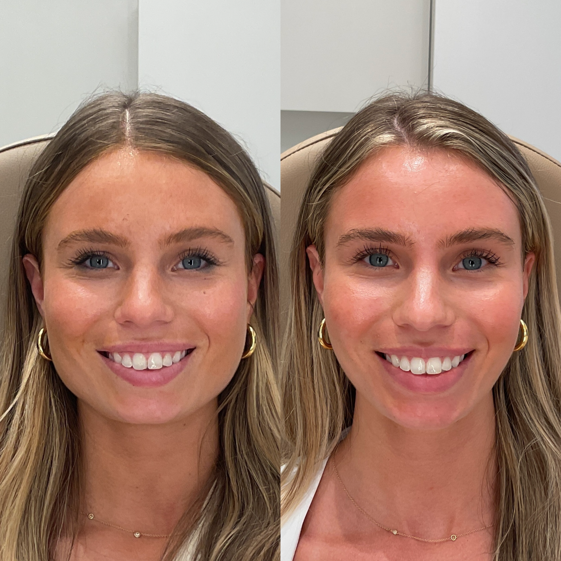 Masseter Botox before and after photographs — Medical Aesthetics Case 28.