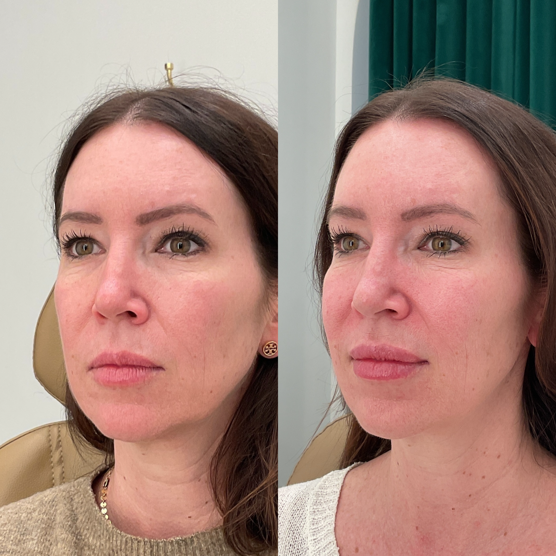 Botox and lip and chin filler before and after photographs — Medical Aesthetics Case 33.