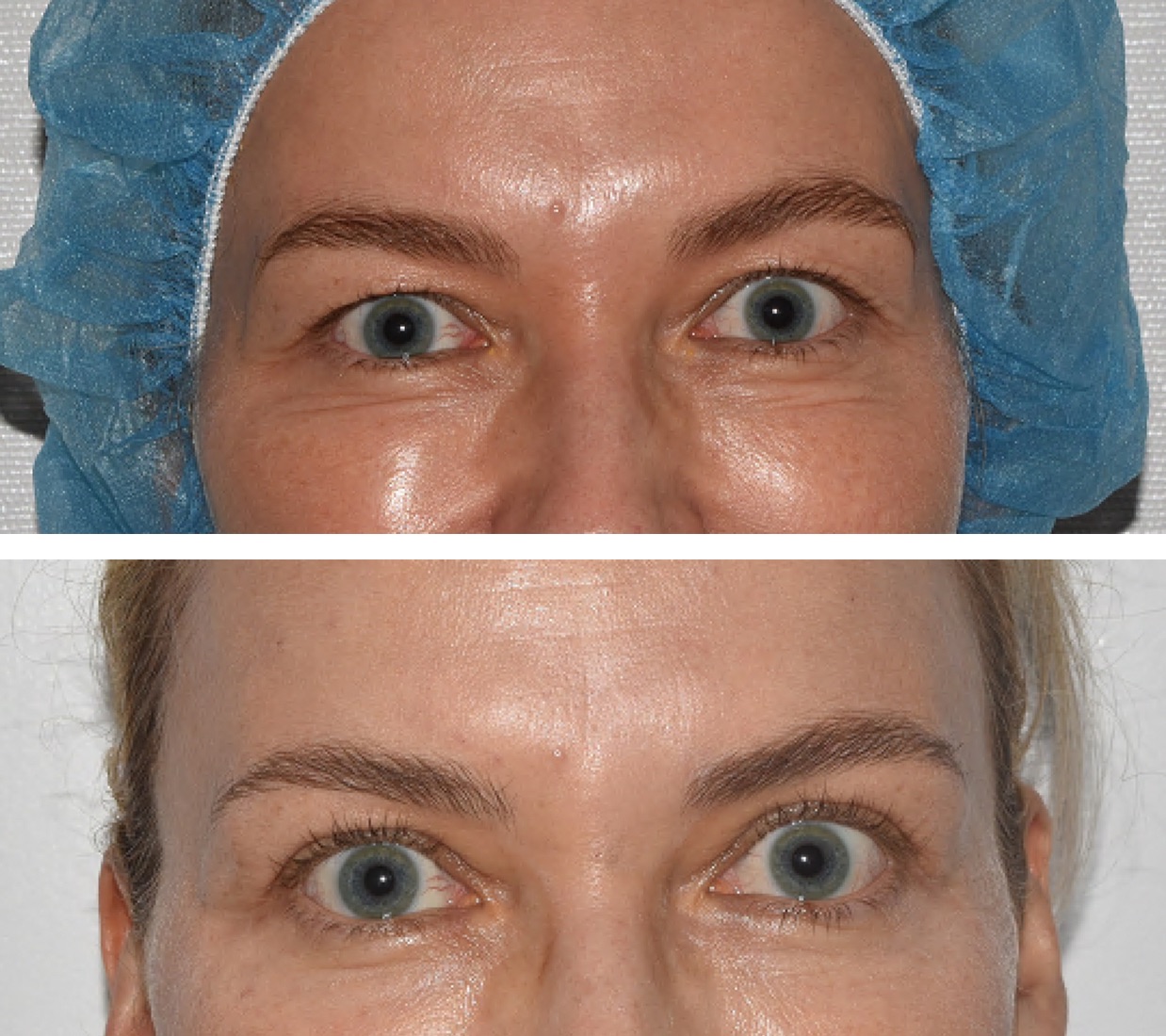 Skin-only upper blepharoplasty for heavy upper lids.