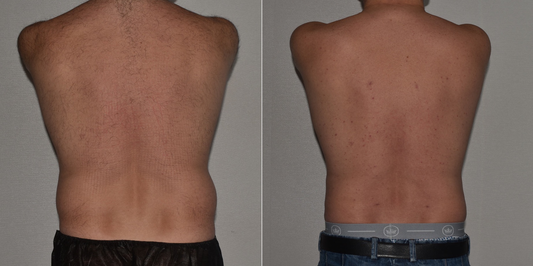 VASER Lipo 360 of the abdomen, flanks and upper back for a more defined contour.