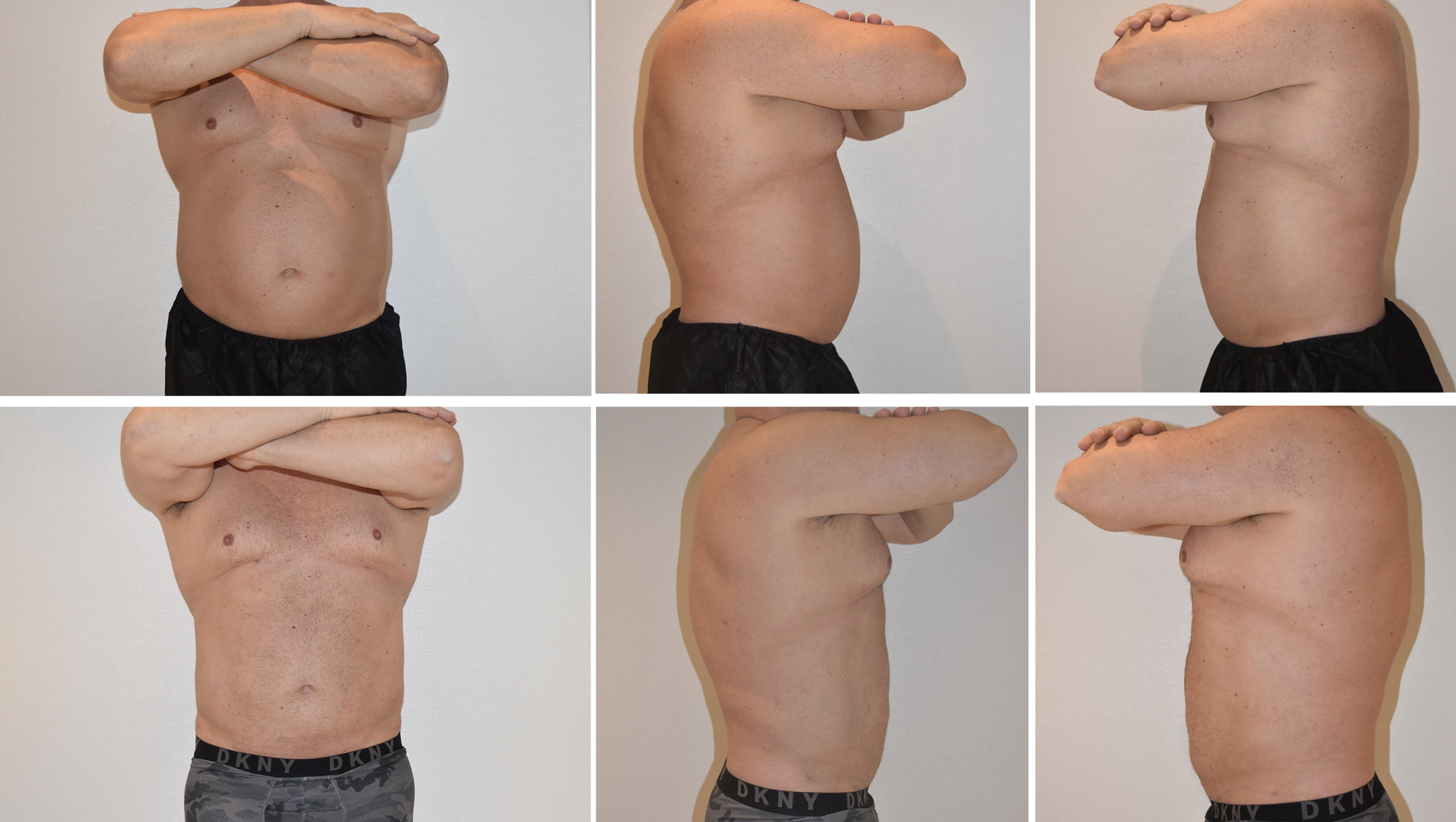 VASER liposuction of subcutaneous abdominal and flank fat for greater definition in a muscular patient; visceral fat was not treated.