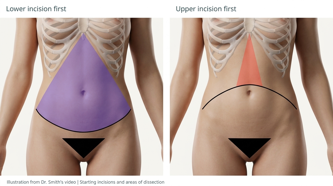 Side-by-side illustration comparing the broad purple dissection area with the lower incision first and the narrower red dissection area with the upper incision first.