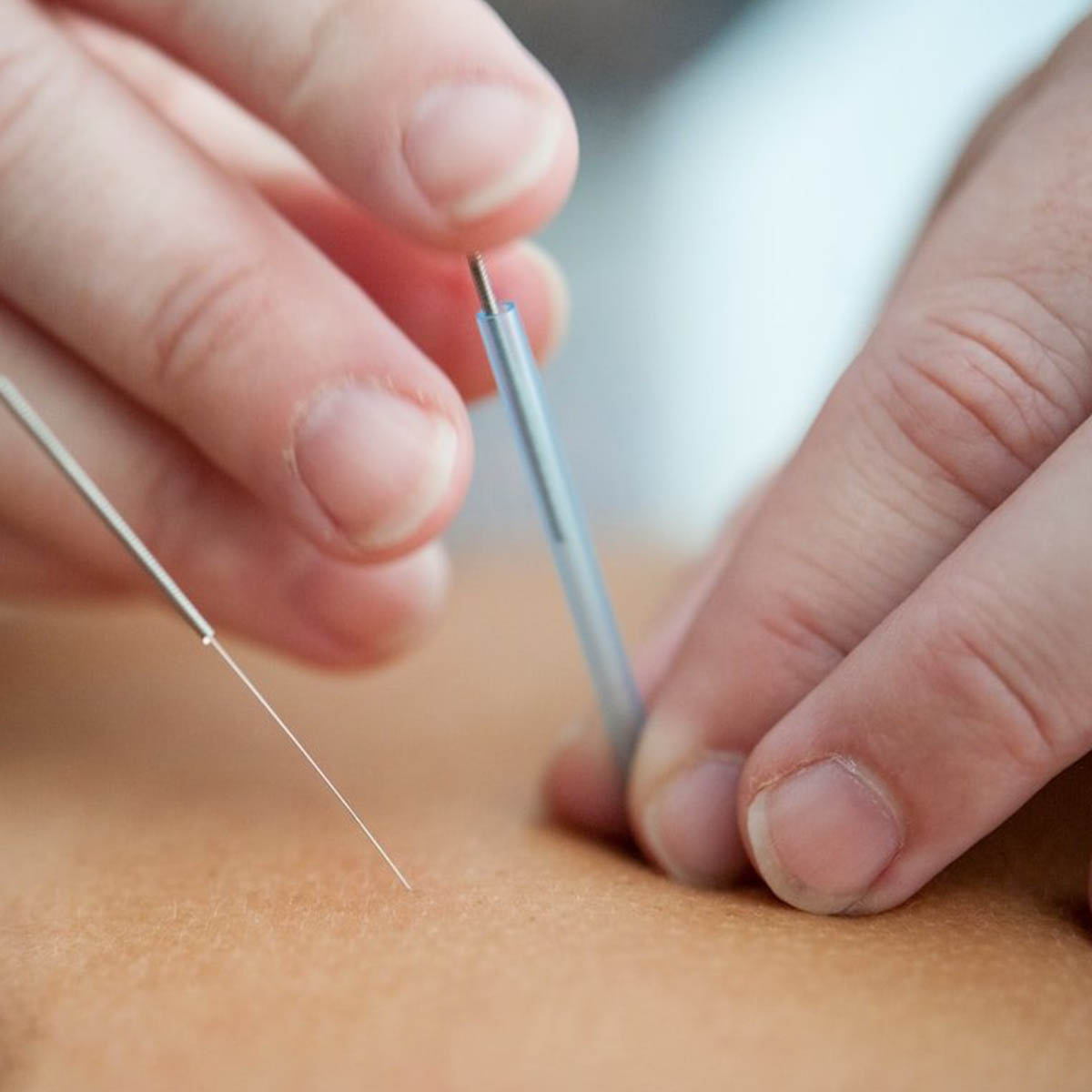 An acuncpture needle is being applied carefully and with skill.