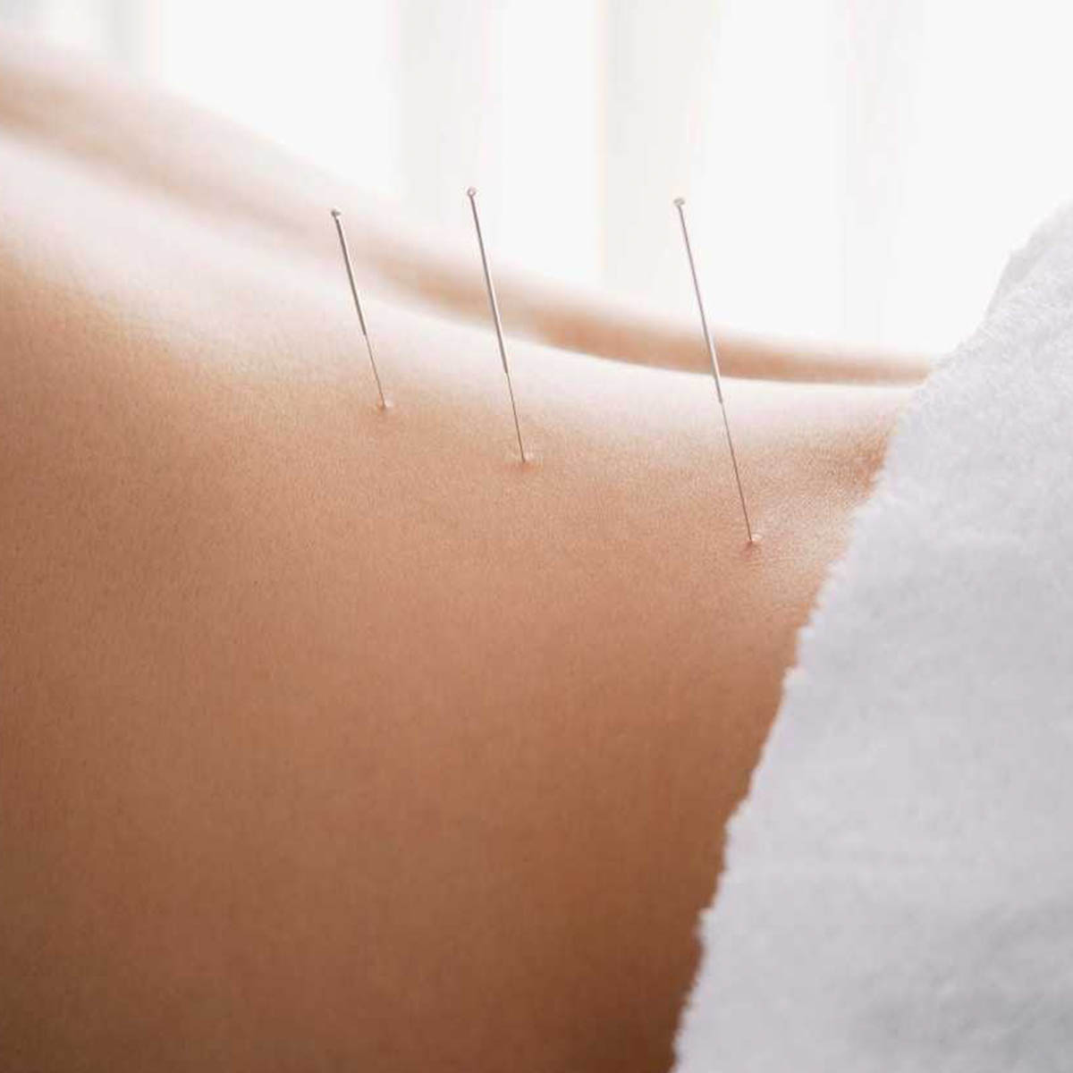 Acupuncture needles are stuck in someone's back. She looks happy about it.
