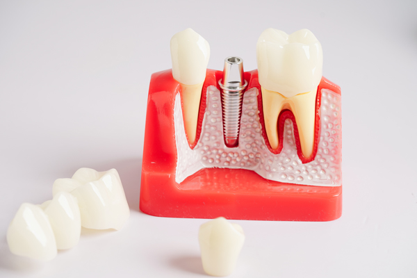 Dental Implant Saratoga, CA