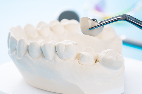 Dental Crowns Saratoga, CA