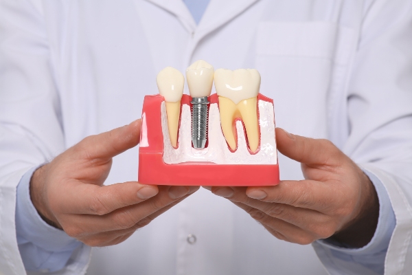 How Long Do Dental Implants Last? from Genuine Care Dental in Saratoga, CA