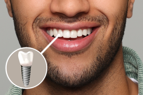Securely Replace Teeth with Dental Implants from Genuine Care Dental in Saratoga, CA