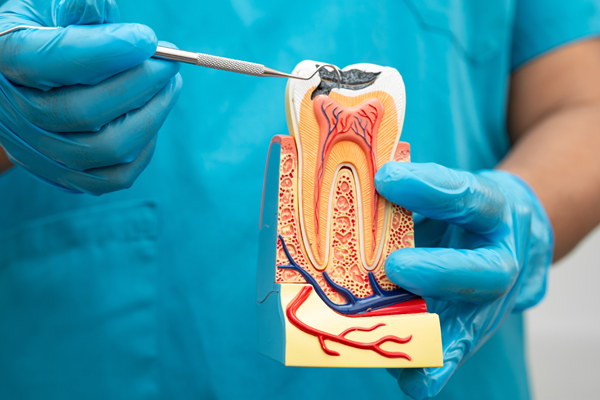 Root Canal Saratoga, CA