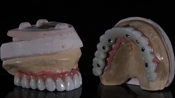 Implant Supported Dentures Saratoga, CA