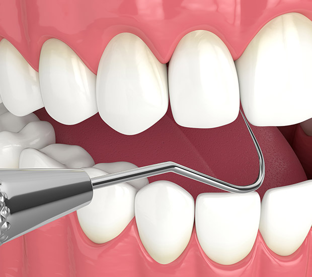 Interactive Periodontal Probing from Genuine Care Dental in Saratoga, CA