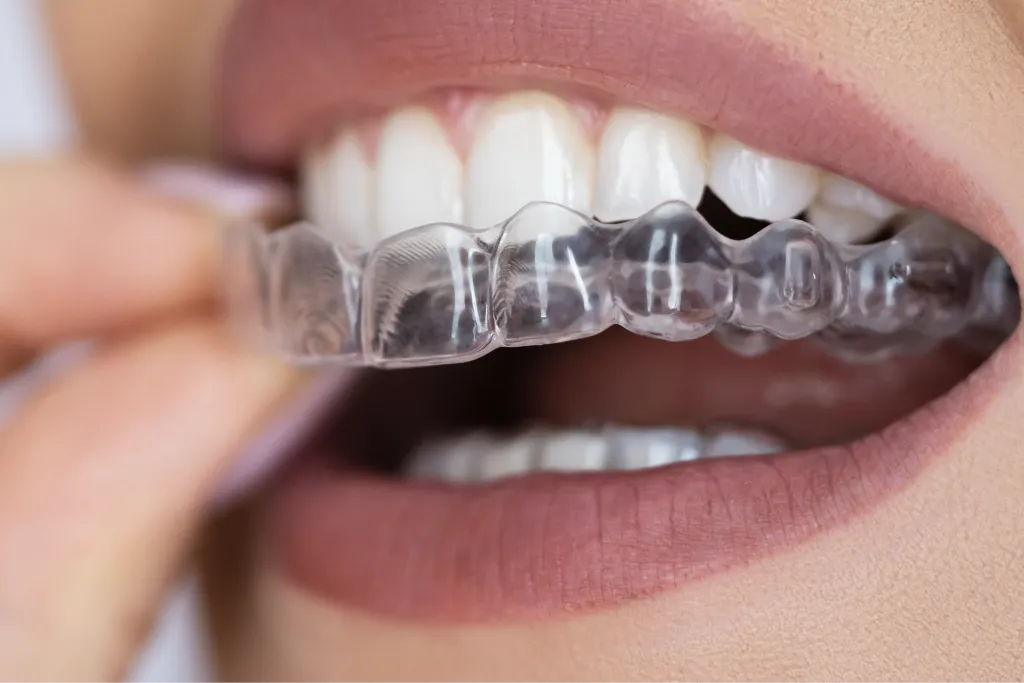 patient wearing Invisalign clear aligners