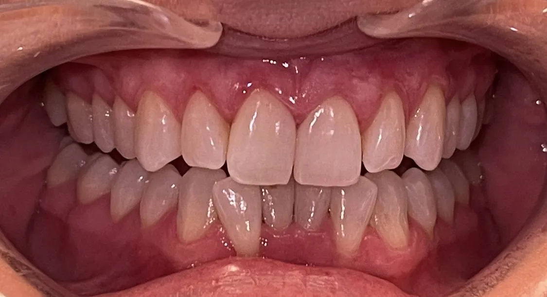 Case 03 before treatment