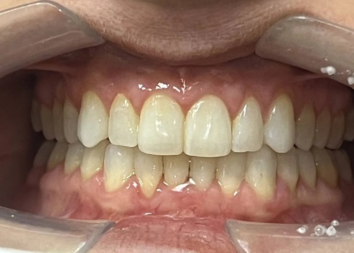 Case 03 after treatment