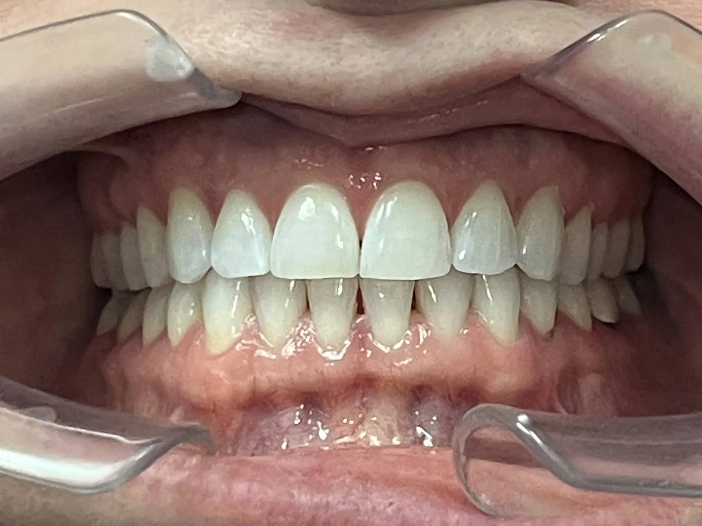 Case 04 after treatment