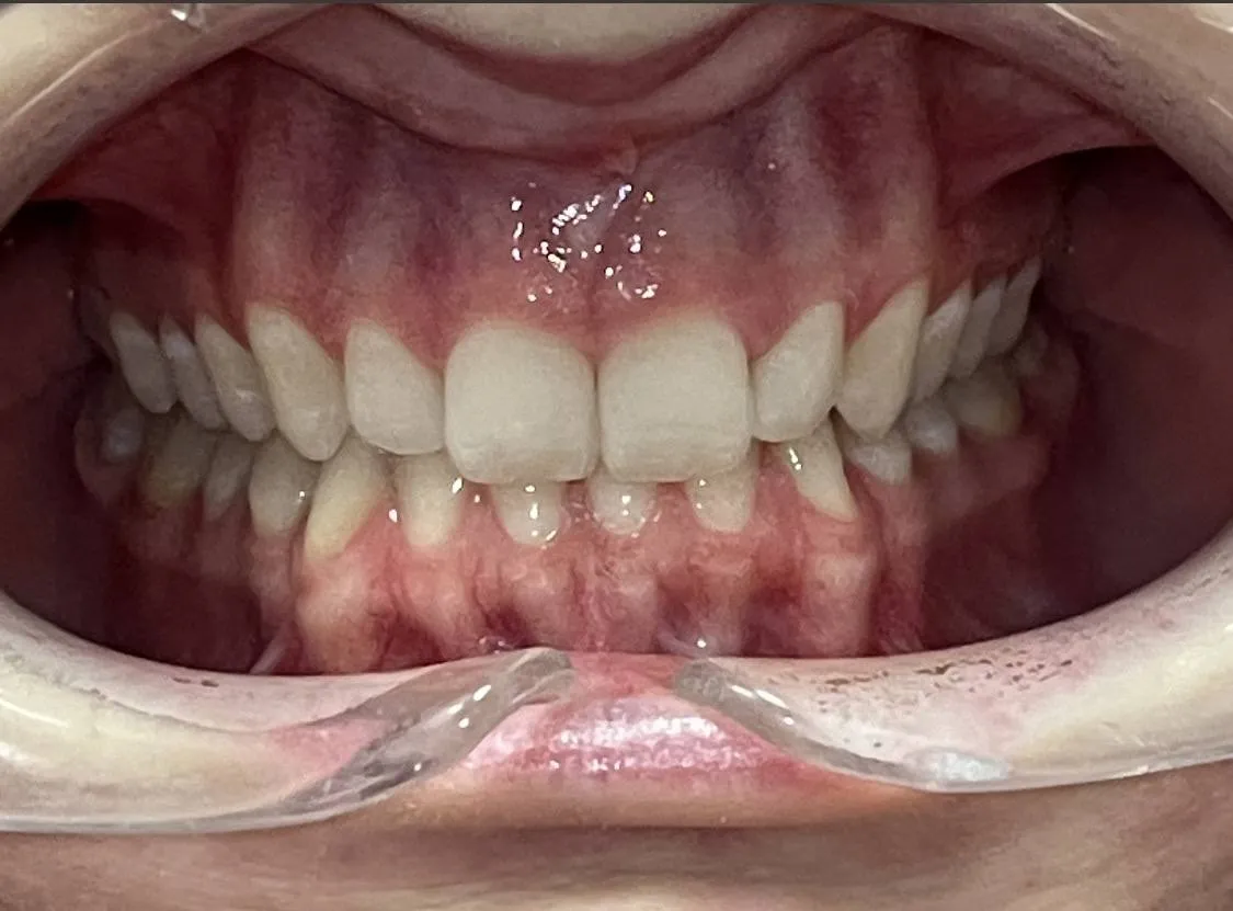 Case 05 before treatment