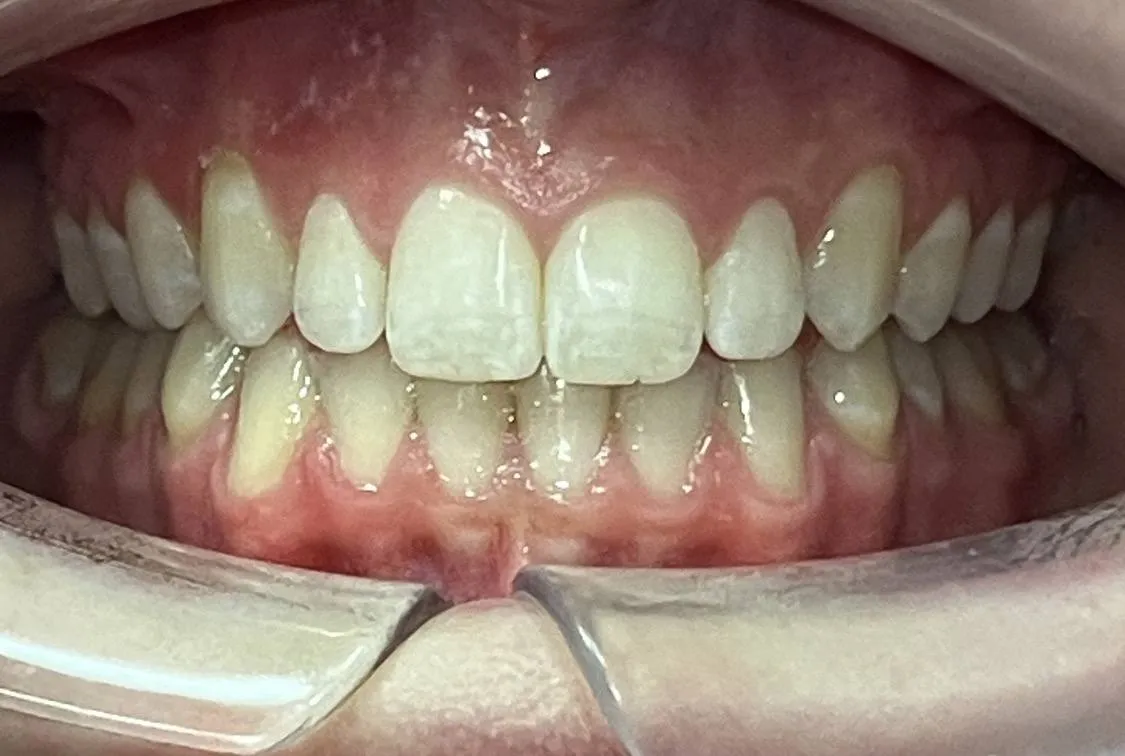 Case 05 after treatment