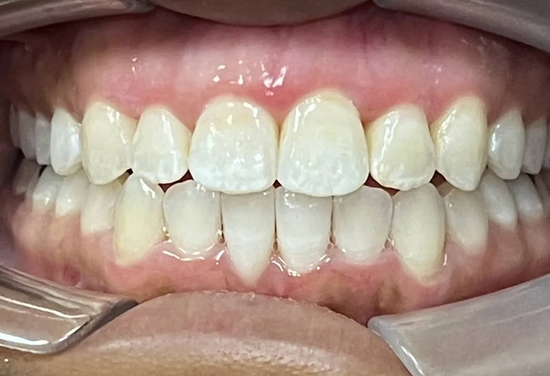 Case 06 after treatment