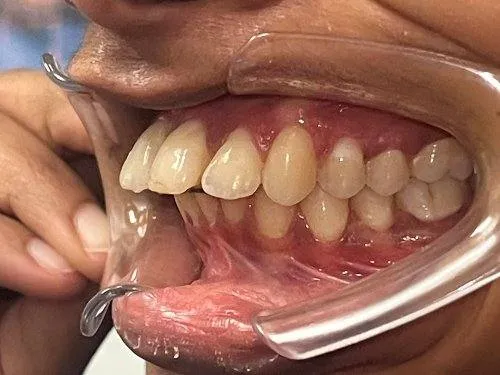 Case 11 before treatment