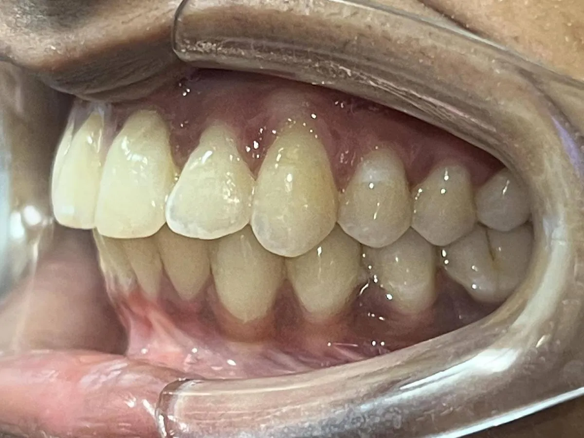 Case 11 after treatment