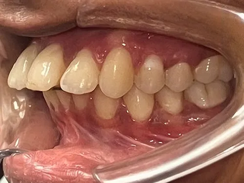 Case 11 before treatment