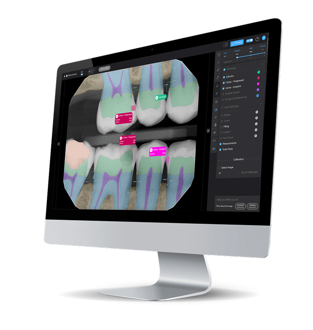 Computer monitor displaying dental X-rays with highlighted sections and labels indicating calculus and various stages of caries on teeth, alongside a menu for analysis tools and calibration on the right side of the screen.