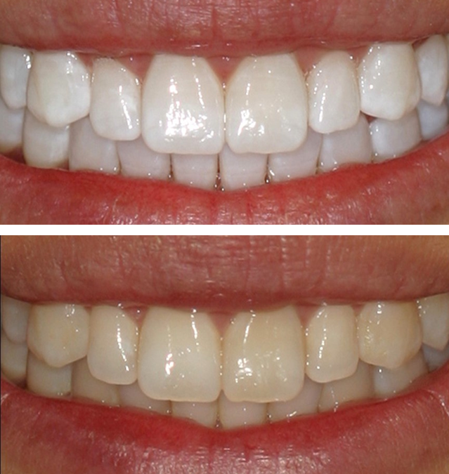 Comparison of two close-up photos of a person's smile showing teeth before and after whitening: the top image shows teeth that are whiter and brighter, while the bottom image shows teeth with a more yellowish tone.